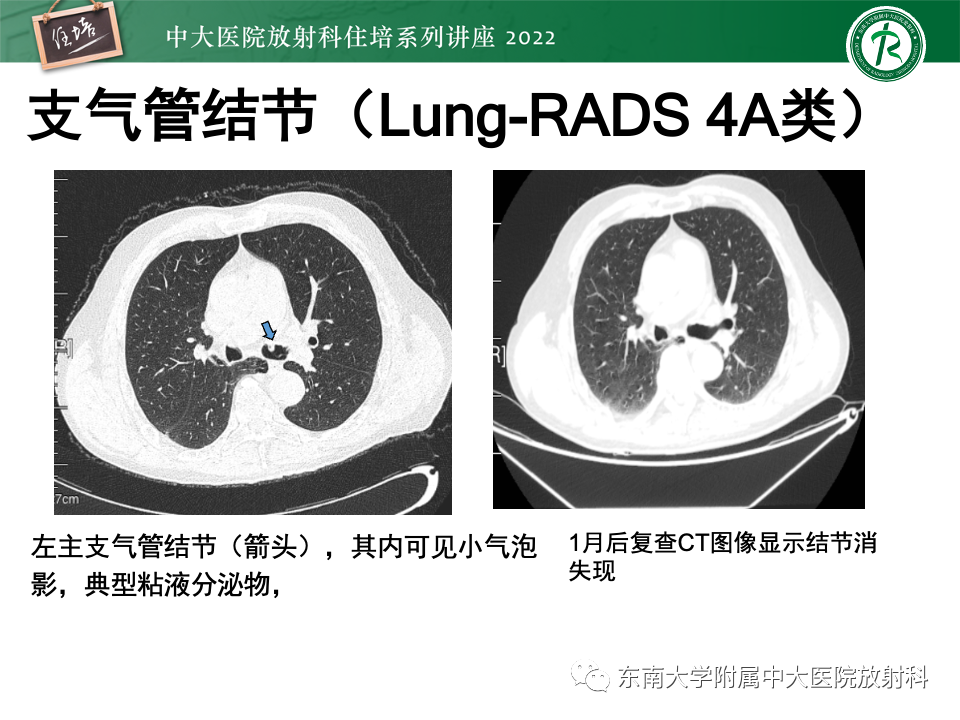 影像PPT - 【PPT】 肺Lung-RADS（V1.1）解读及临床应用要点-39