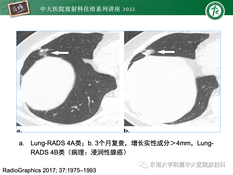 影像PPT - 【PPT】 肺Lung-RADS（V1.1）解读及临床应用要点-45