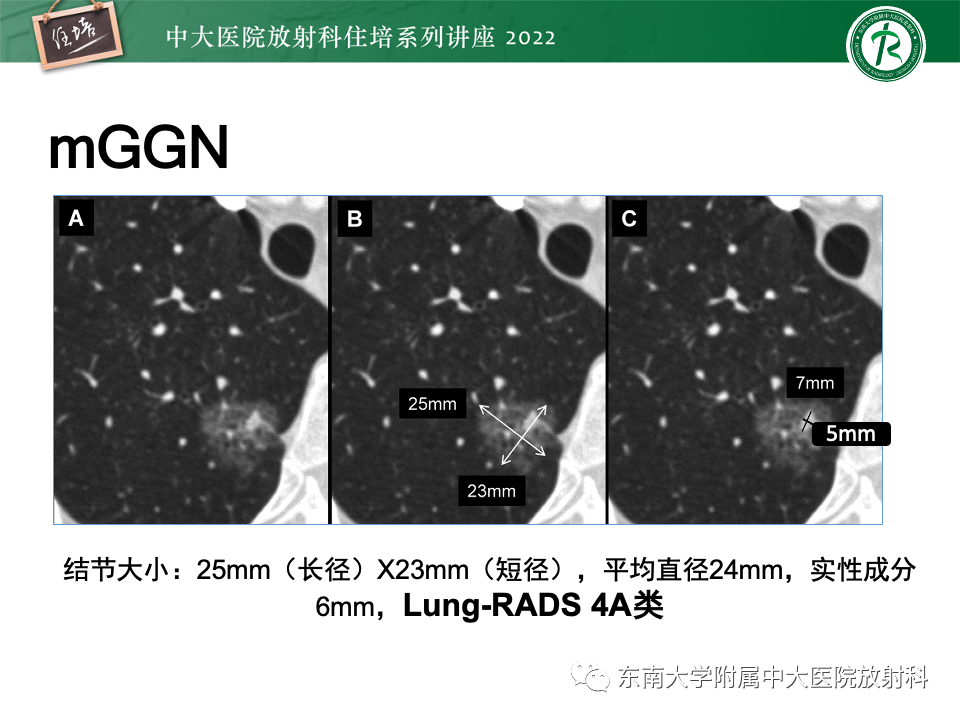 影像PPT - 【PPT】 肺Lung-RADS（V1.1）解读及临床应用要点-38