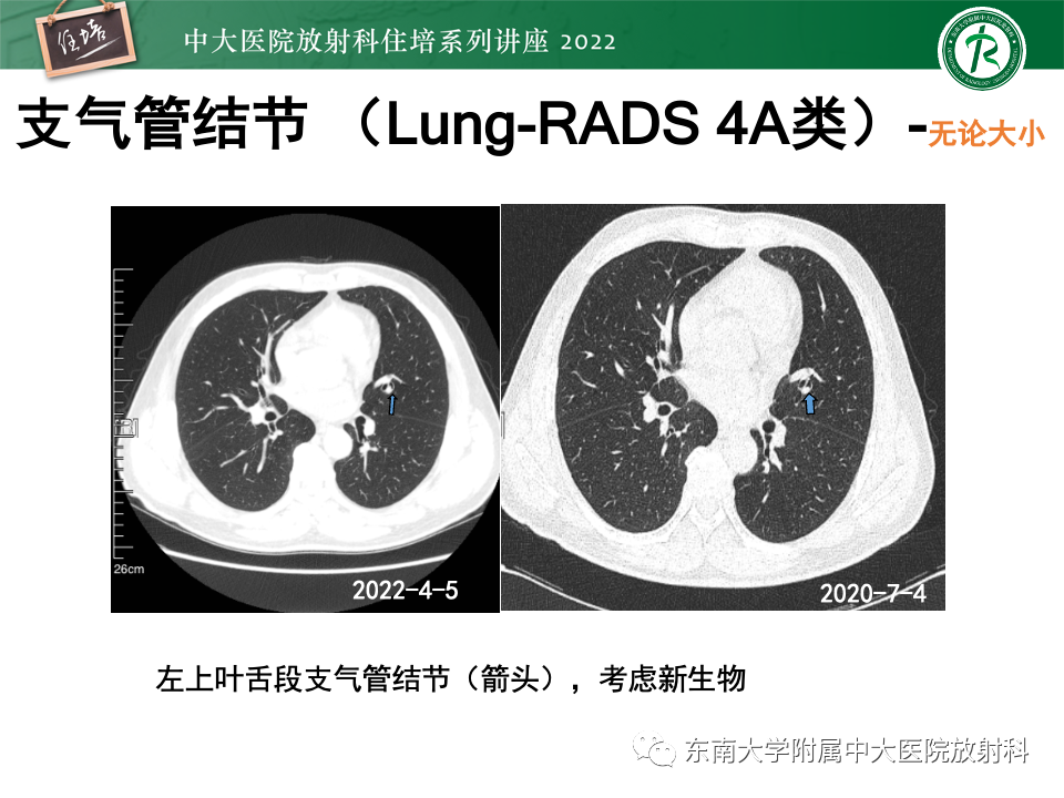影像PPT - 【PPT】 肺Lung-RADS（V1.1）解读及临床应用要点-40