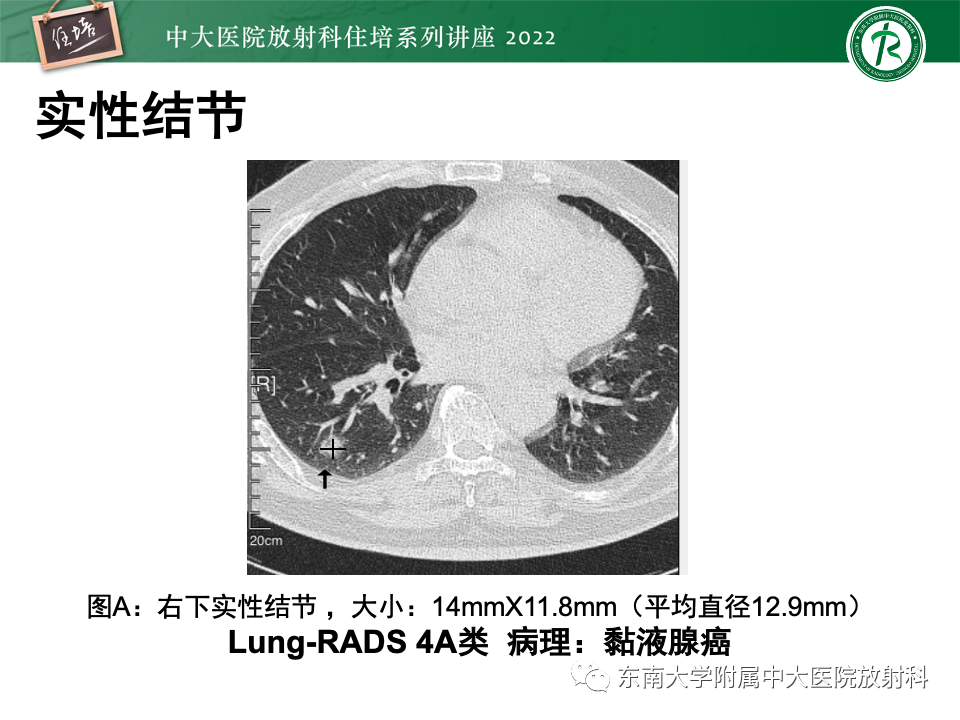 影像PPT - 【PPT】 肺Lung-RADS（V1.1）解读及临床应用要点-37