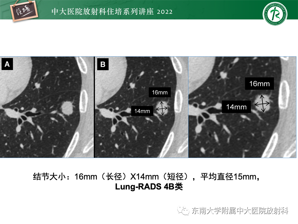 影像PPT - 【PPT】 肺Lung-RADS（V1.1）解读及临床应用要点-42