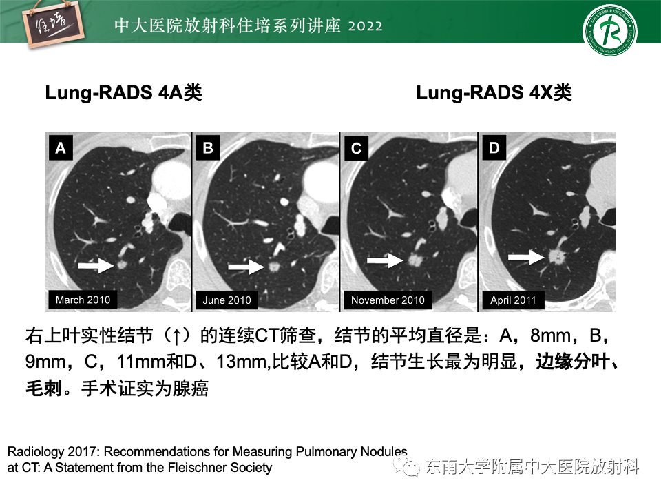 影像PPT - 【PPT】 肺Lung-RADS（V1.1）解读及临床应用要点-47