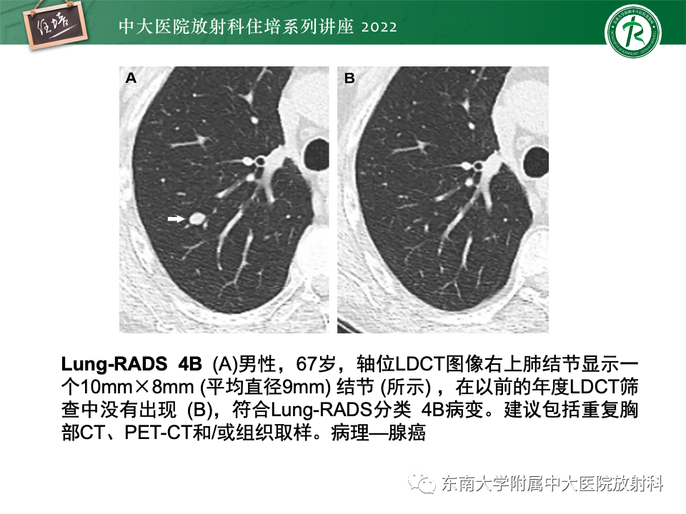 影像PPT - 【PPT】 肺Lung-RADS（V1.1）解读及临床应用要点-43