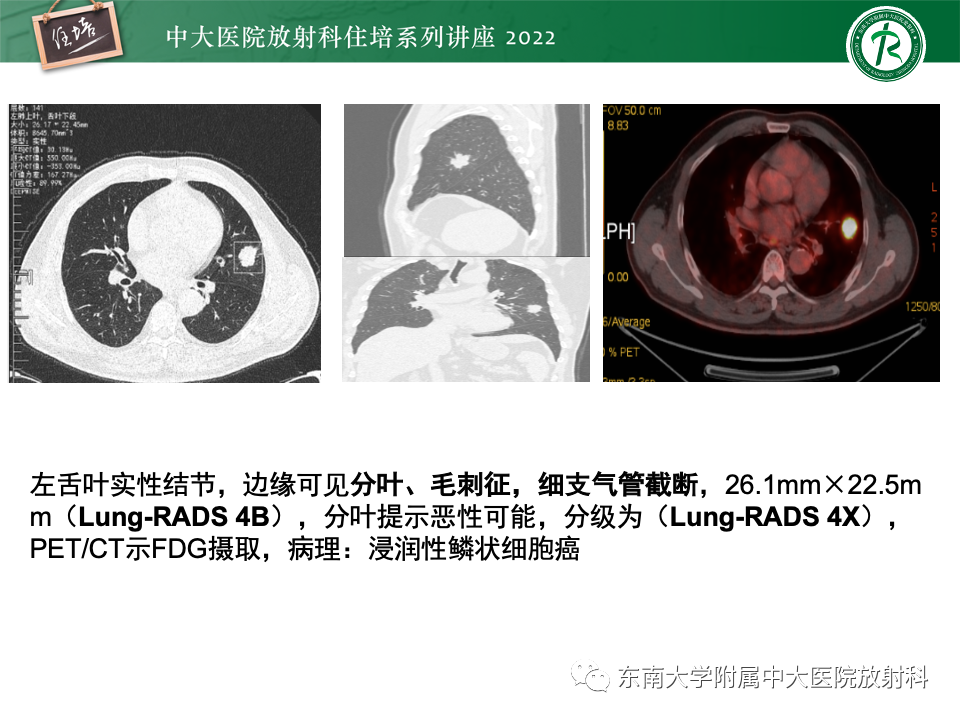 影像PPT - 【PPT】 肺Lung-RADS（V1.1）解读及临床应用要点-48