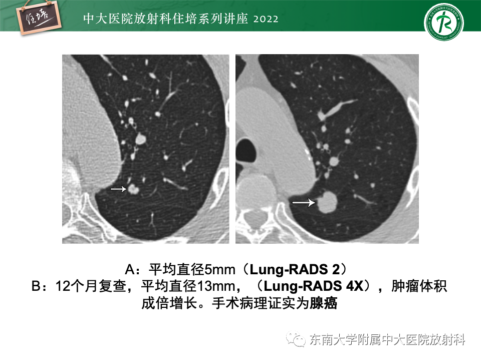 影像PPT - 【PPT】 肺Lung-RADS（V1.1）解读及临床应用要点-49
