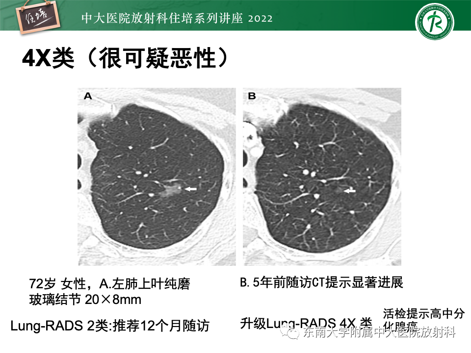 影像PPT - 【PPT】 肺Lung-RADS（V1.1）解读及临床应用要点-50
