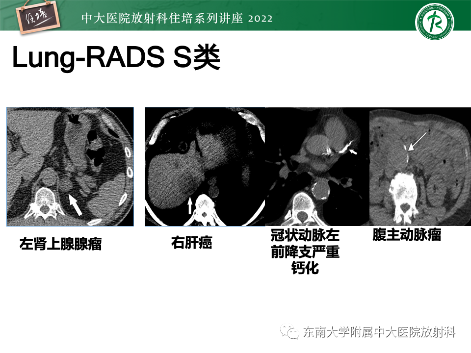 影像PPT - 【PPT】 肺Lung-RADS（V1.1）解读及临床应用要点-52