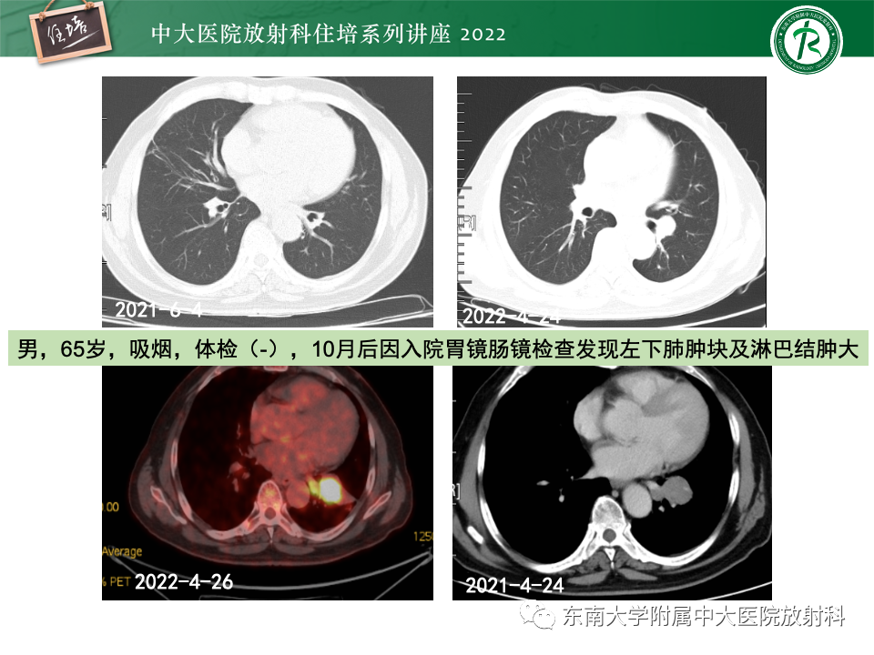 影像PPT - 【PPT】 肺Lung-RADS（V1.1）解读及临床应用要点-57