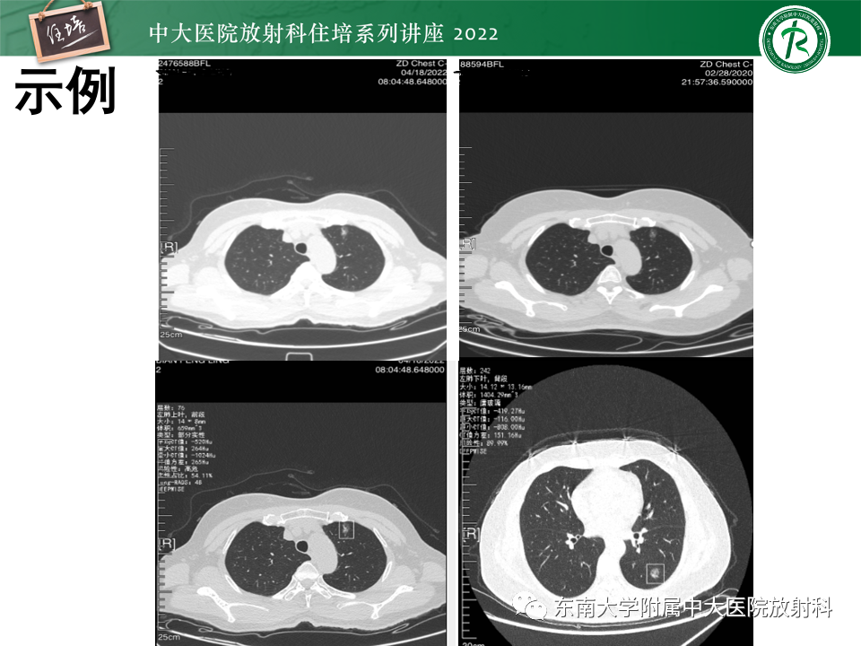 影像PPT - 【PPT】 肺Lung-RADS（V1.1）解读及临床应用要点-63