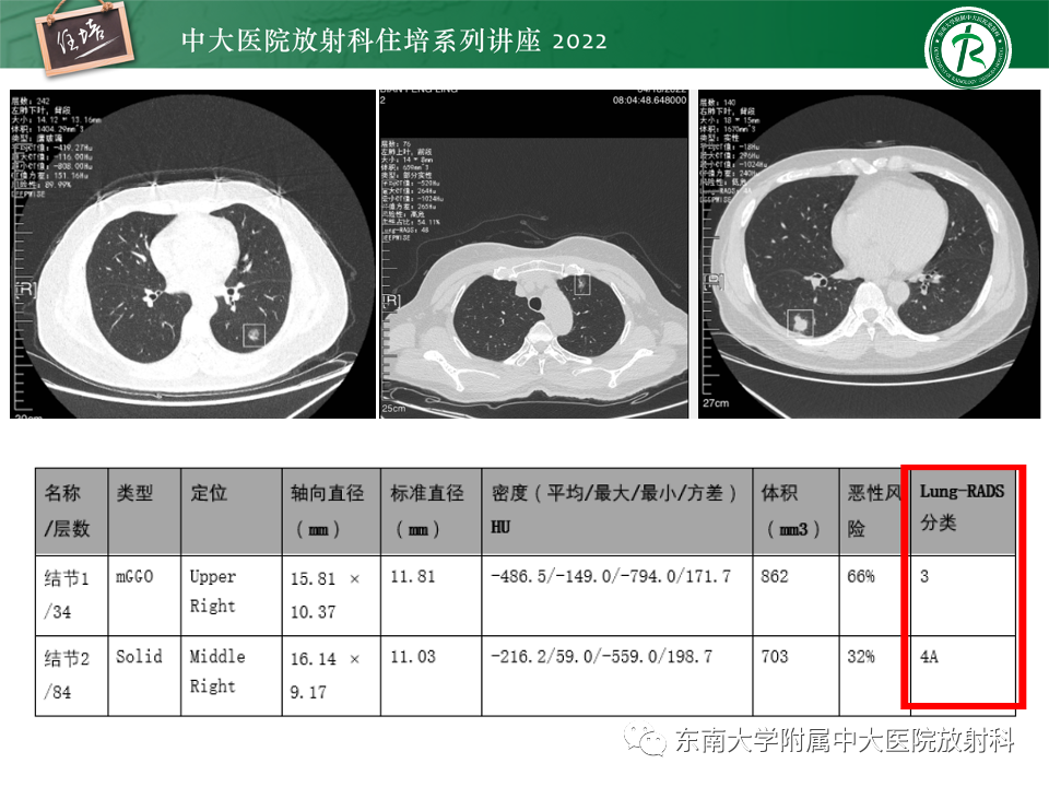 影像PPT - 【PPT】 肺Lung-RADS（V1.1）解读及临床应用要点-66