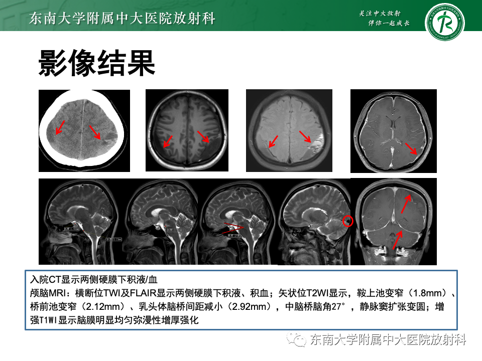 影像PPT - 【PPT】低颅压综合征的MRI表现-4 影像PPT - 【PPT】低颅压综合征的MRI表现-4