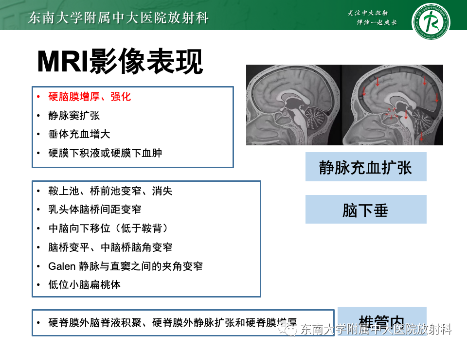 影像PPT - 【PPT】低颅压综合征的MRI表现-17 影像PPT - 【PPT】低颅压综合征的MRI表现-17