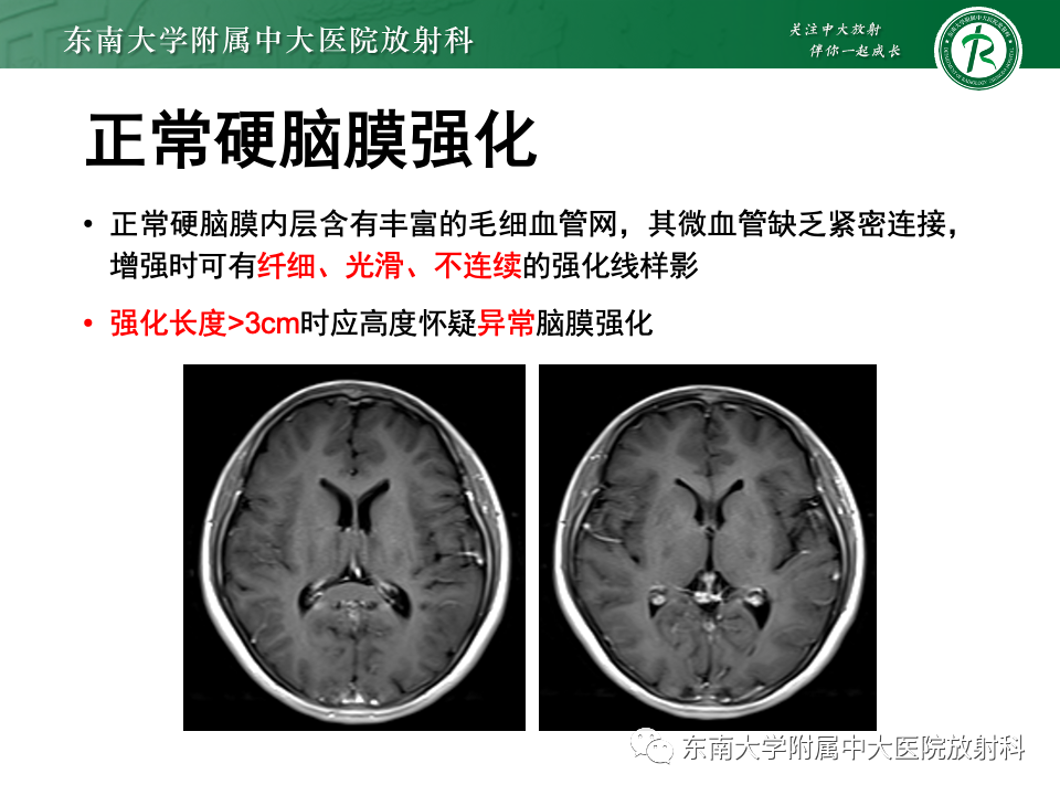 影像PPT - 【PPT】低颅压综合征的MRI表现-18 影像PPT - 【PPT】低颅压综合征的MRI表现-18