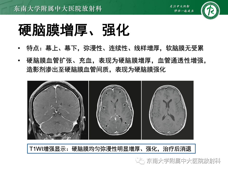 影像PPT - 【PPT】低颅压综合征的MRI表现-19 影像PPT - 【PPT】低颅压综合征的MRI表现-19