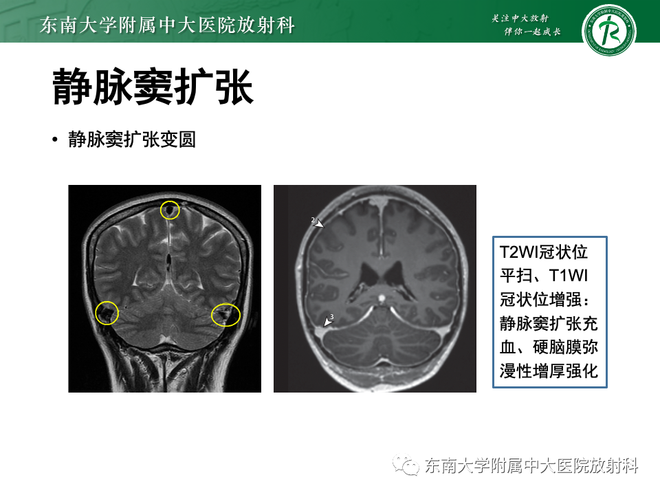 影像PPT - 【PPT】低颅压综合征的MRI表现-20 影像PPT - 【PPT】低颅压综合征的MRI表现-20