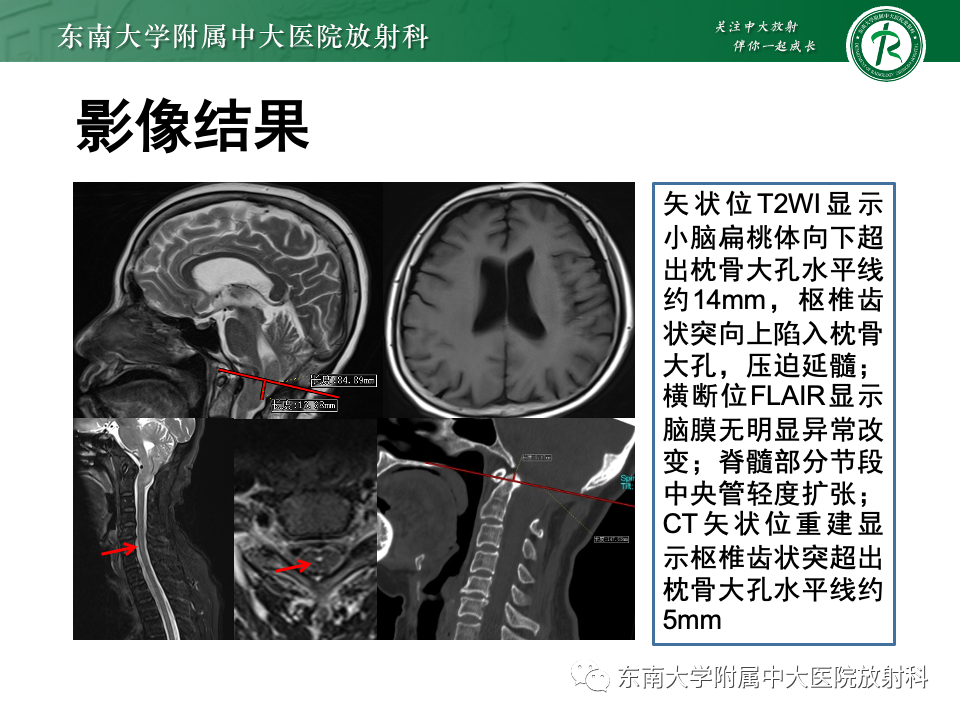 影像PPT - 【PPT】低颅压综合征的MRI表现-36 影像PPT - 【PPT】低颅压综合征的MRI表现-36