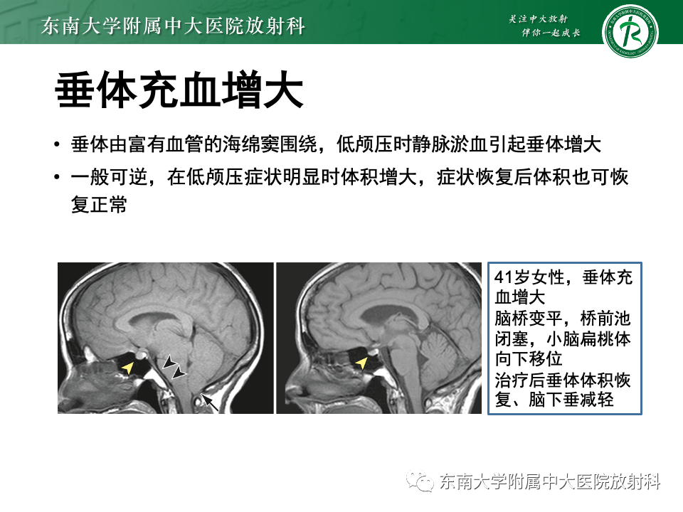 影像PPT - 【PPT】低颅压综合征的MRI表现-21 影像PPT - 【PPT】低颅压综合征的MRI表现-21
