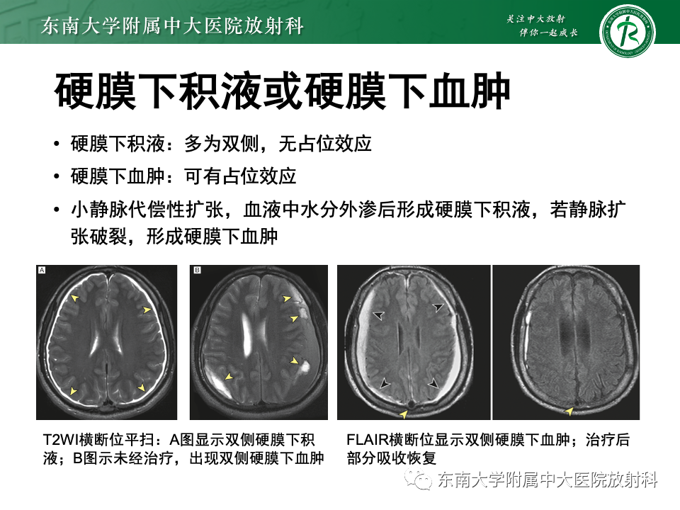 影像PPT - 【PPT】低颅压综合征的MRI表现-22 影像PPT - 【PPT】低颅压综合征的MRI表现-22