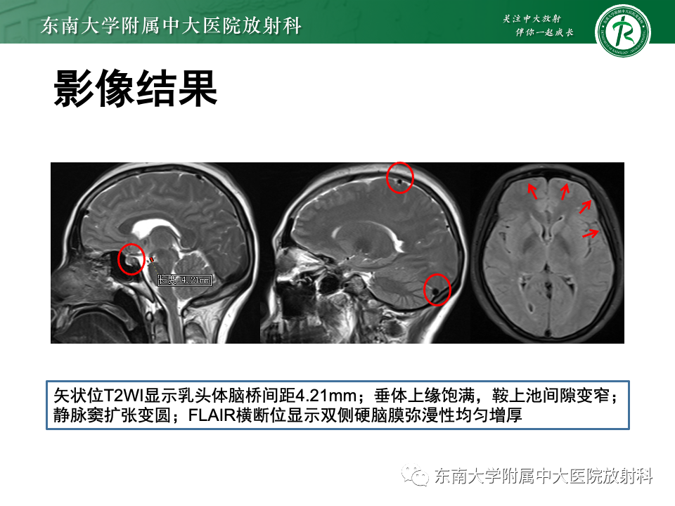 影像PPT - 【PPT】低颅压综合征的MRI表现-26 影像PPT - 【PPT】低颅压综合征的MRI表现-26