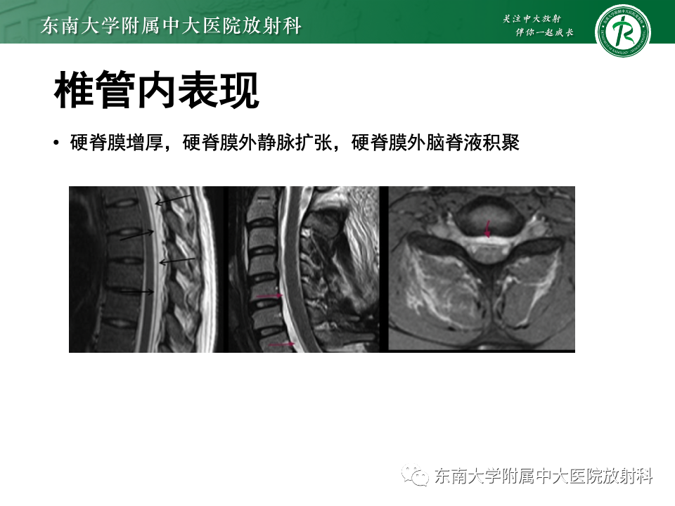 影像PPT - 【PPT】低颅压综合征的MRI表现-24 影像PPT - 【PPT】低颅压综合征的MRI表现-24