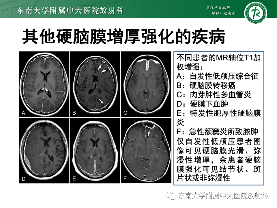 影像PPT - 【PPT】低颅压综合征的MRI表现-30 影像PPT - 【PPT】低颅压综合征的MRI表现-30