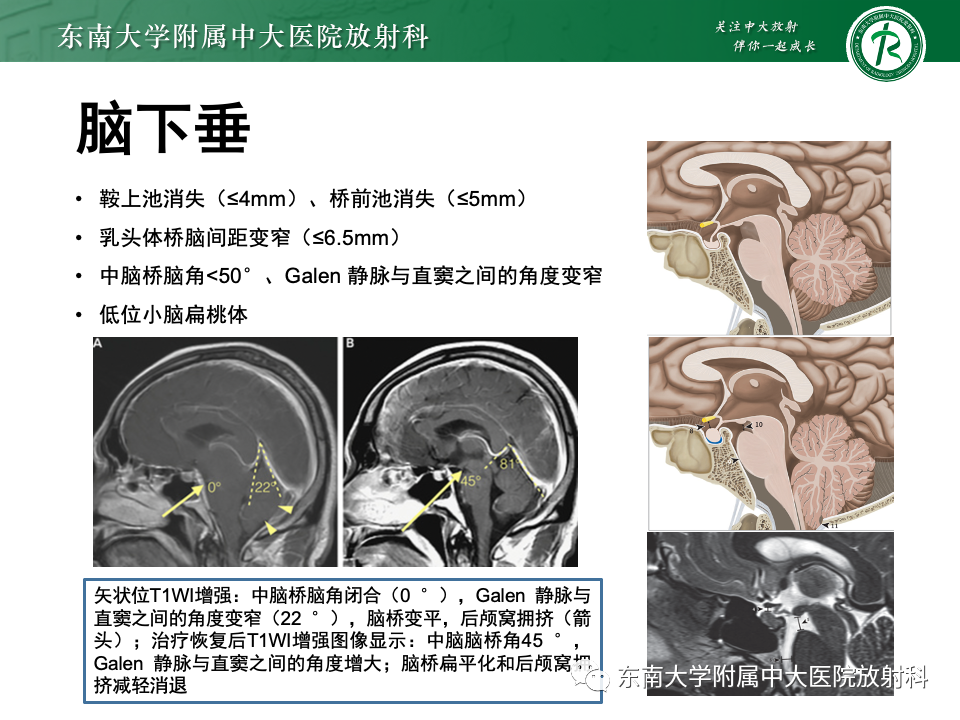 影像PPT - 【PPT】低颅压综合征的MRI表现-23 影像PPT - 【PPT】低颅压综合征的MRI表现-23