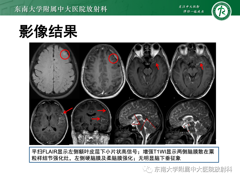 影像PPT - 【PPT】低颅压综合征的MRI表现-32 影像PPT - 【PPT】低颅压综合征的MRI表现-32