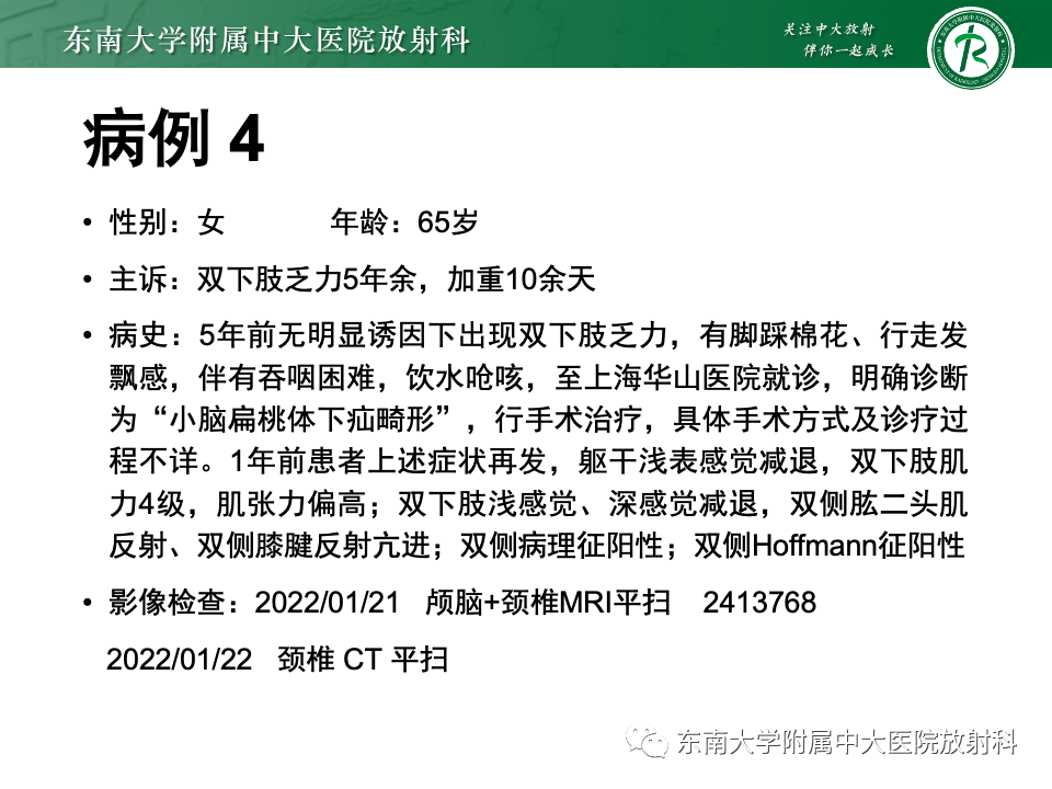 影像PPT - 【PPT】低颅压综合征的MRI表现-35 影像PPT - 【PPT】低颅压综合征的MRI表现-35