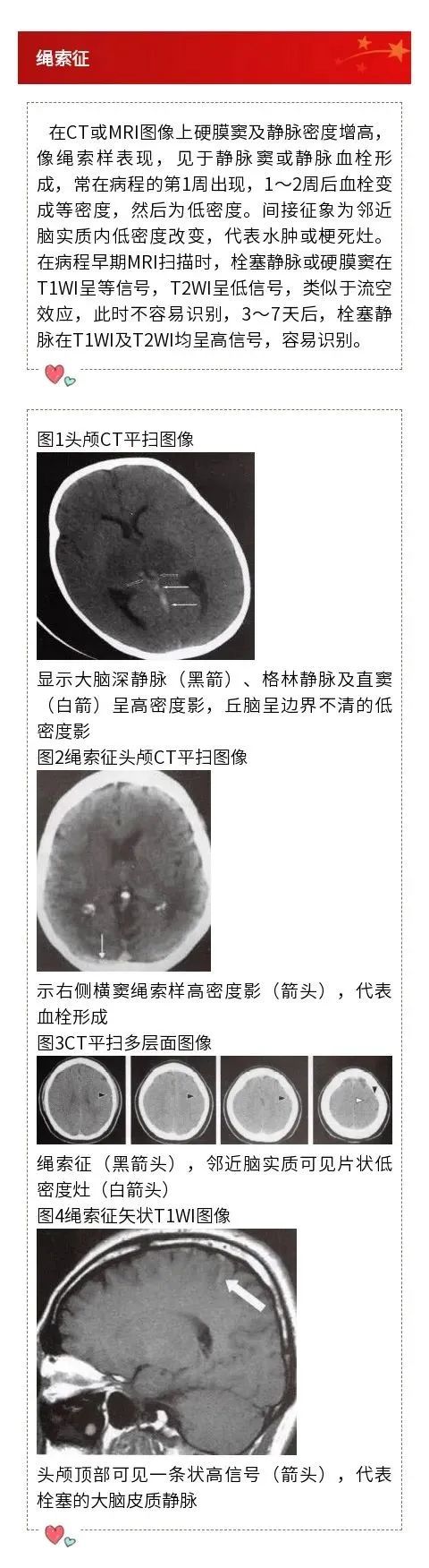 影像PPT - 和颅内静脉相关的“绳索征”-1