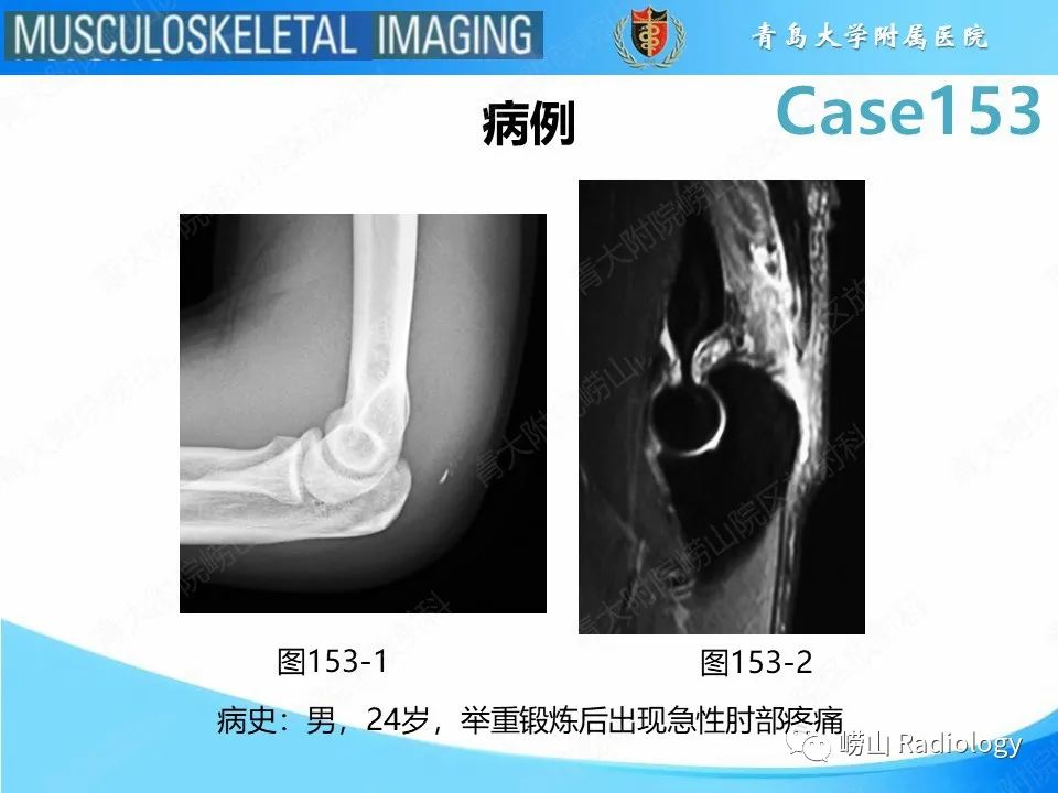 影像PPT - 【PPT】肱三头肌肌腱撕裂-2