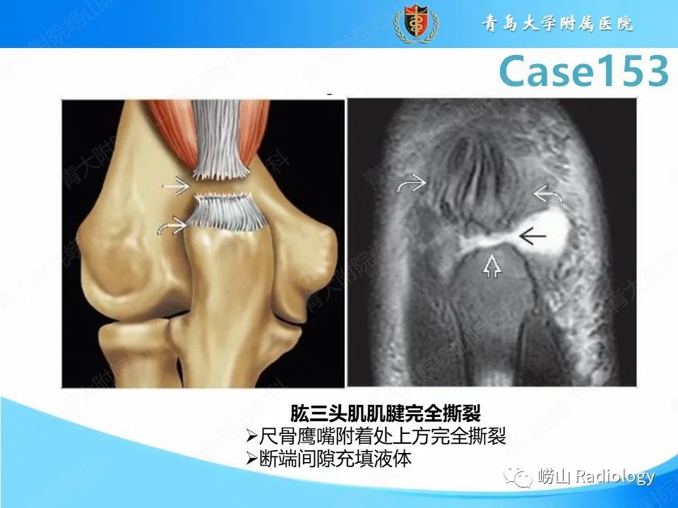 影像PPT - 【PPT】肱三头肌肌腱撕裂-16