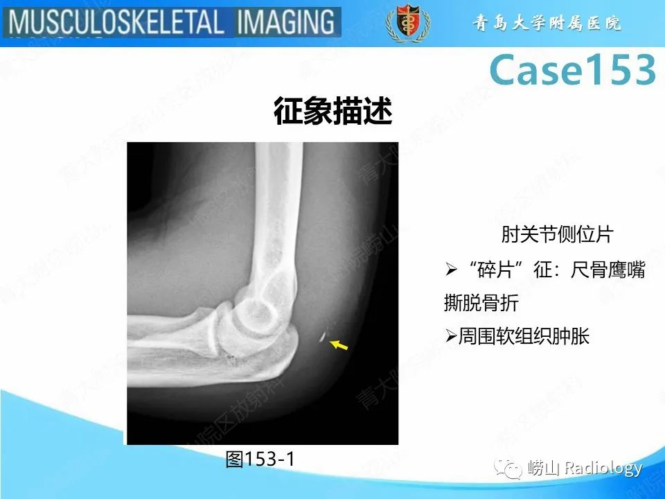 影像PPT - 【PPT】肱三头肌肌腱撕裂-18