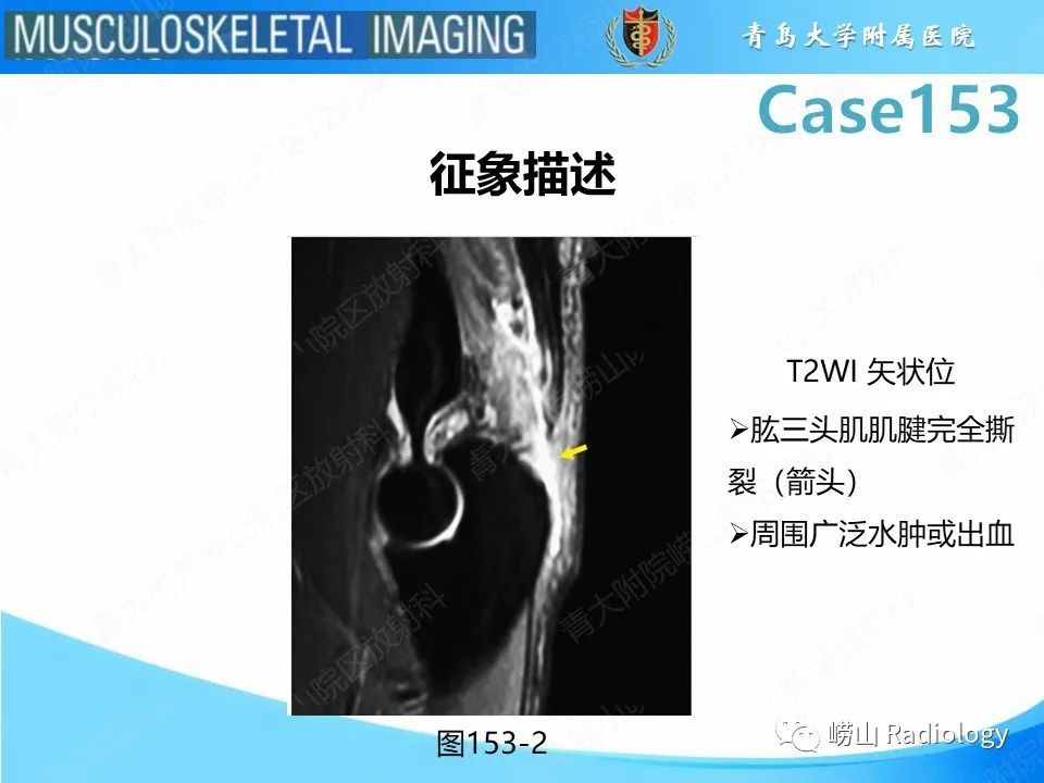 影像PPT - 【PPT】肱三头肌肌腱撕裂-19