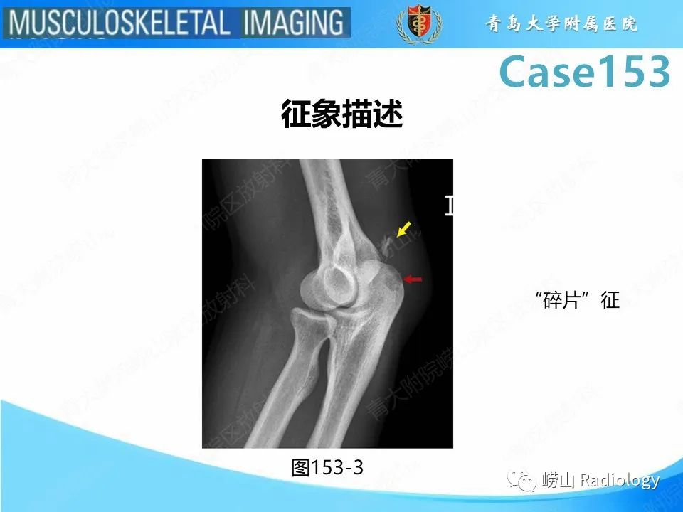 影像PPT - 【PPT】肱三头肌肌腱撕裂-20