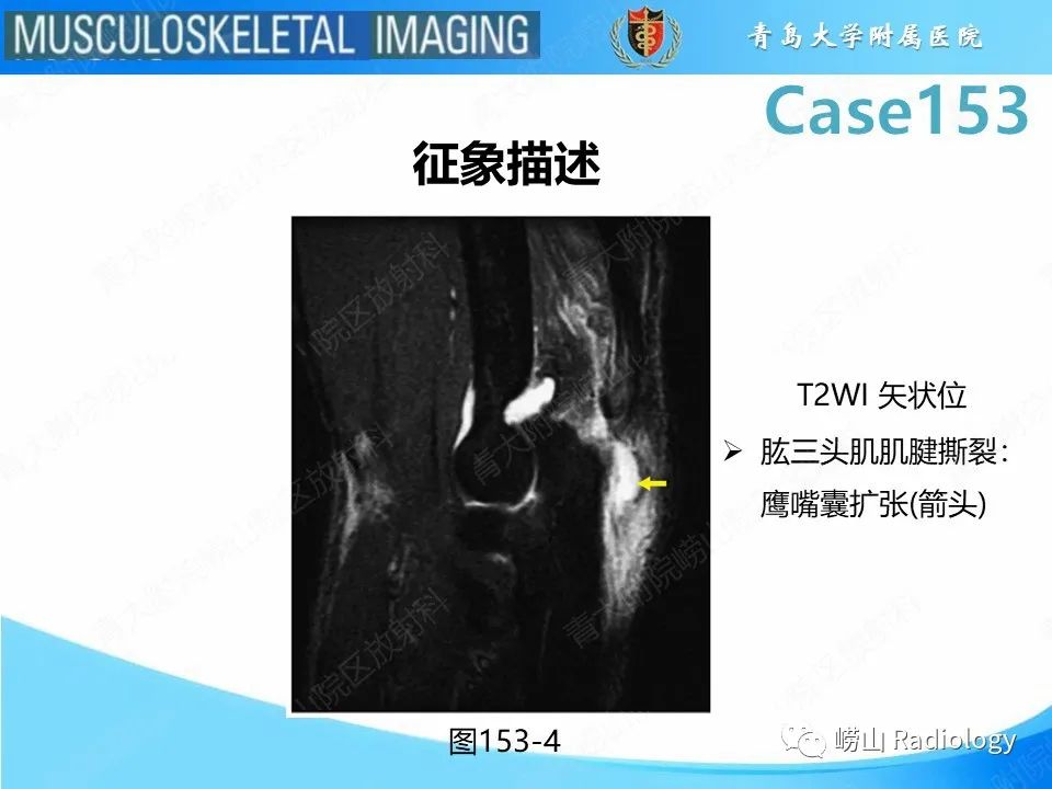 影像PPT - 【PPT】肱三头肌肌腱撕裂-21
