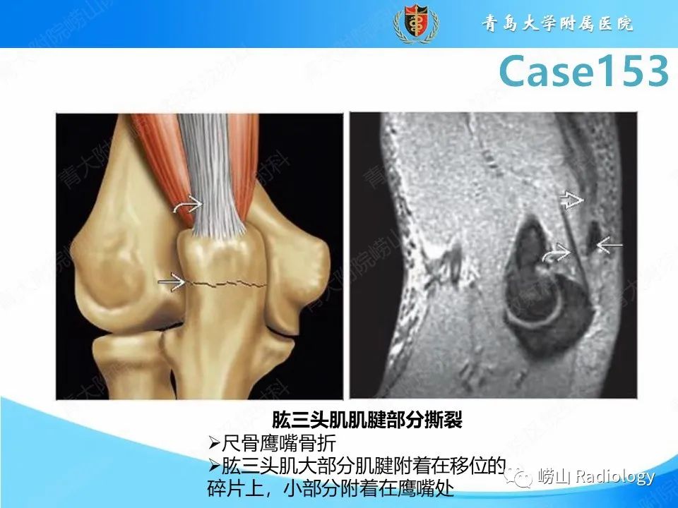 影像PPT - 【PPT】肱三头肌肌腱撕裂-17