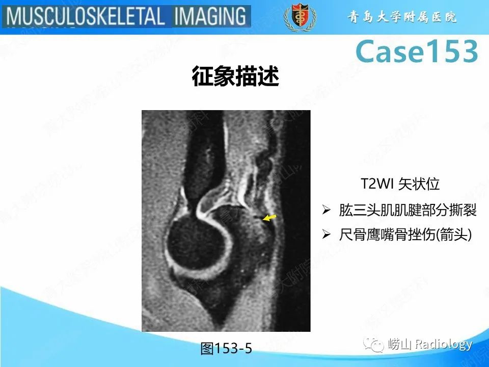 影像PPT - 【PPT】肱三头肌肌腱撕裂-22