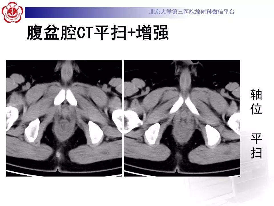 影像PPT - 【PPT】肛周脓肿-3