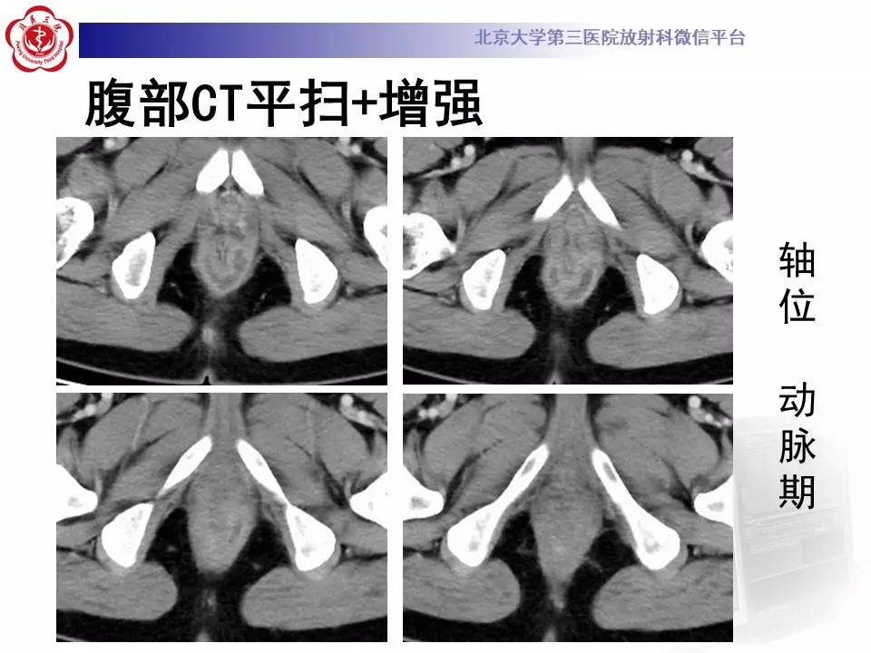 影像PPT - 【PPT】肛周脓肿-4