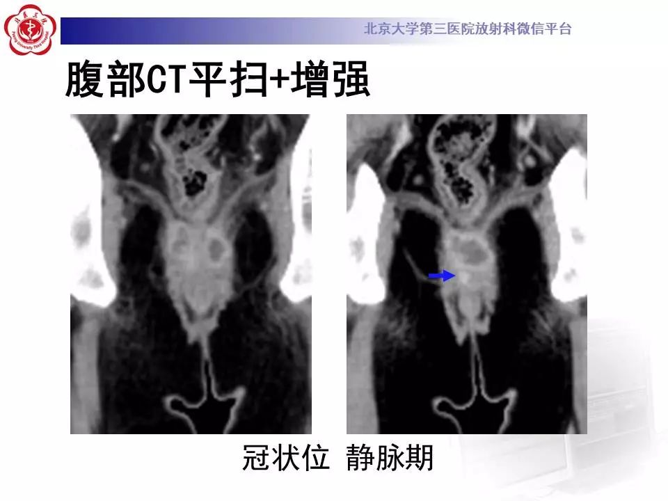 影像PPT - 【PPT】肛周脓肿-6