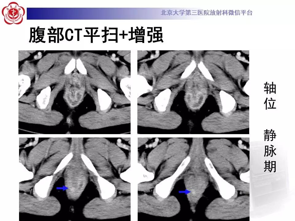 影像PPT - 【PPT】肛周脓肿-5
