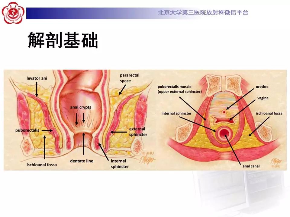 影像PPT - 【PPT】肛周脓肿-11