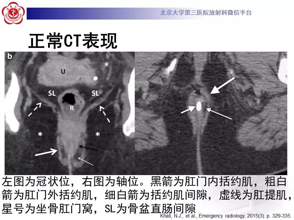 影像PPT - 【PPT】肛周脓肿-12