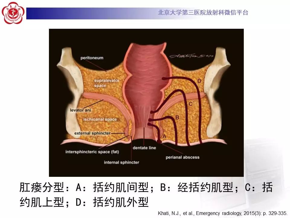 影像PPT - 【PPT】肛周脓肿-15