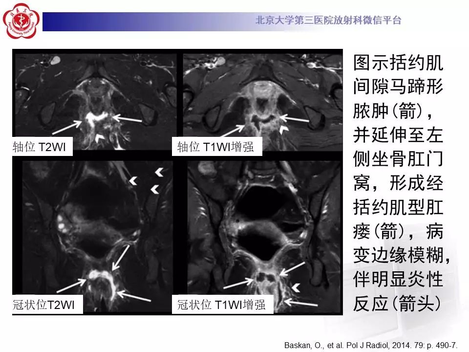 影像PPT - 【PPT】肛周脓肿-23