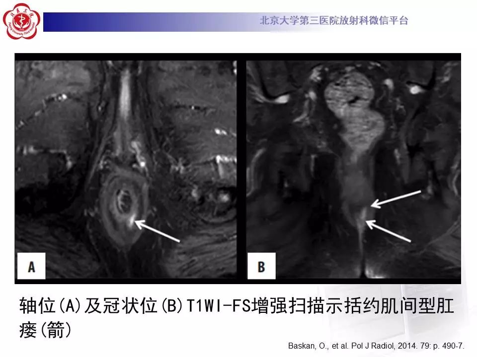 影像PPT - 【PPT】肛周脓肿-24