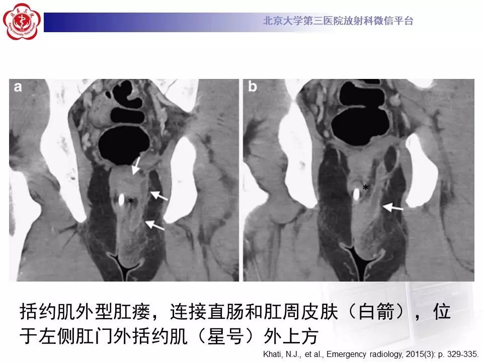 影像PPT - 【PPT】肛周脓肿-25