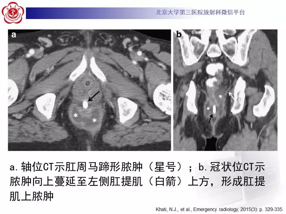 影像PPT - 【PPT】肛周脓肿-22