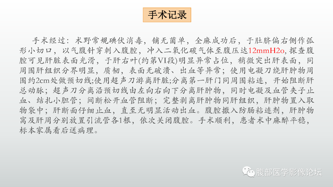 影像PPT - 【PPT】肝细胞腺瘤-8